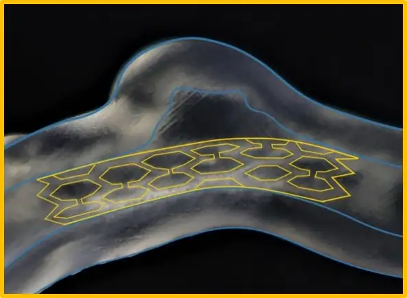 Im Projekt wurden verschiedene Prototypen intrakranieller Stents zur Validierung des 3D-gedrucktem Gefäßmodells implantiert.
