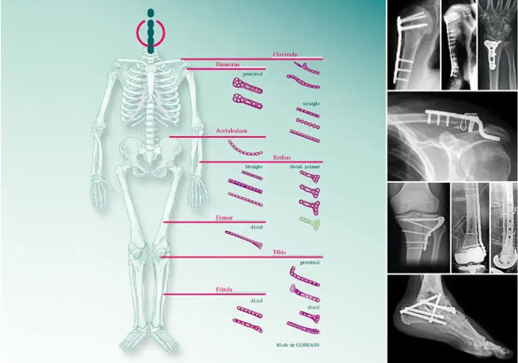 Übersicht von Implantaten im menschlichen Körper, schematisch, auf Röntgenbilder